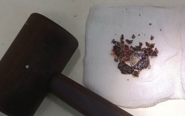 Người đàn ông 'quên' đồng xu trong mũi hơn 50 năm Ảnh 2