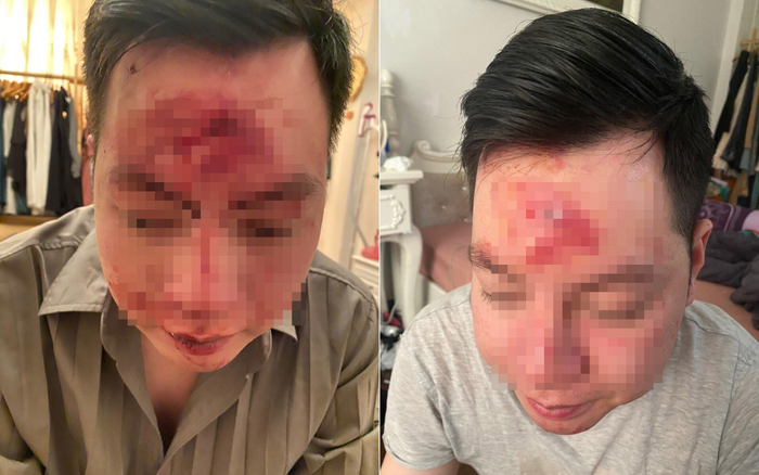 Khách bị nhân viên quán bar hành hung vì mời rượu không uống phải theo dõi gãy xương mũi Ảnh 2