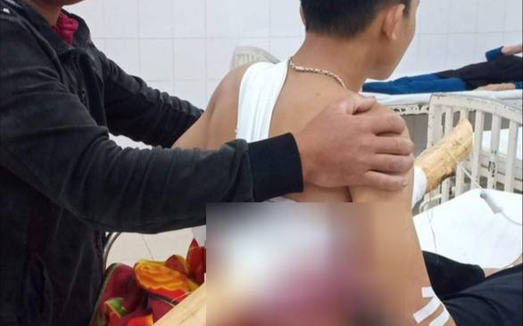 Không kịp hãm phanh do phóng xe với tốc độ cao, nam sinh bị cây keo dài gần 2m đâm xuyên người Ảnh 2