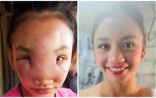 Thiếu nữ 17 tuổi nguy cơ bị mù vì 'bệnh lạ' sau khi nặn mụn Ảnh 2