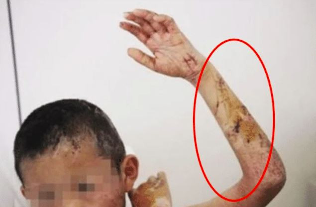 Tiểu Đinh thường bị bố đánh đập dã man.