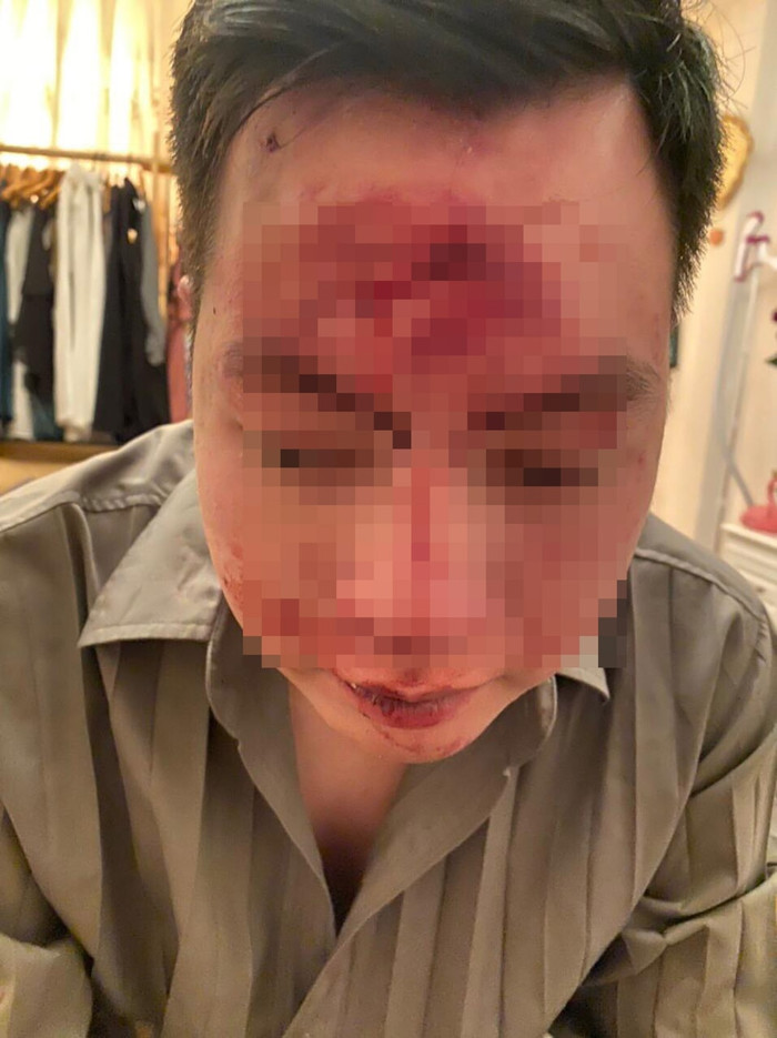 Anh T. bị rách trán sau khi nhóm người hành hung.