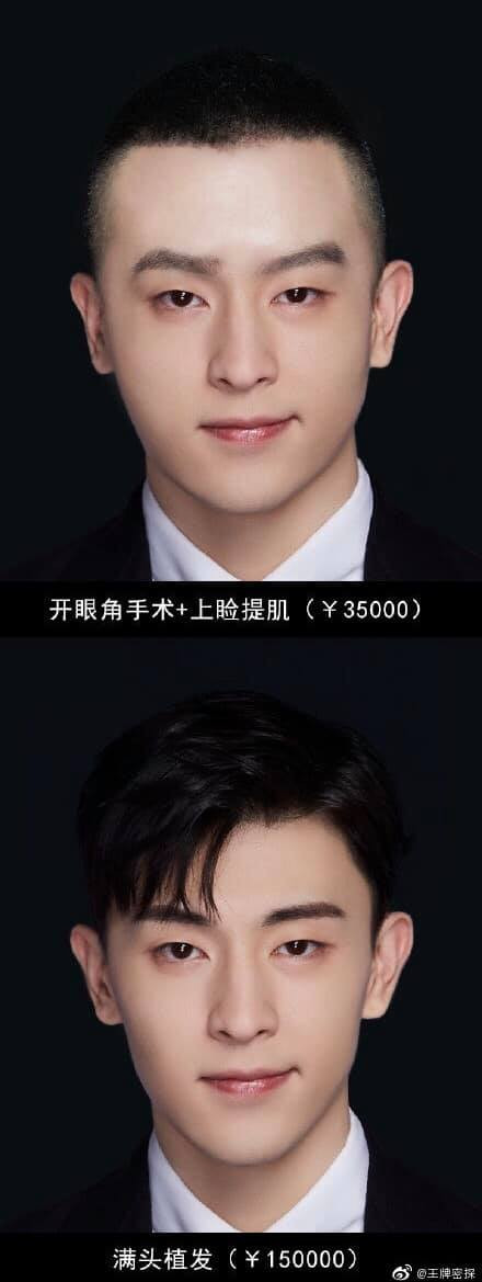 3 bước cuối sẽ là cắt mở hốc mắt, nâng cơ mặt và cuối cùng là cấy tóc