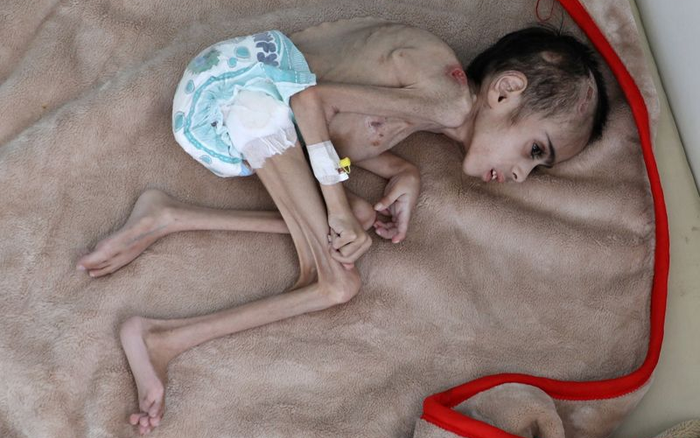 Xót xa hình ảnh cậu bé 7 tuổi bị liệt nặng vỏn vẹn 7kg, gầy trơ xương đang nằm hấp hối Ảnh 2