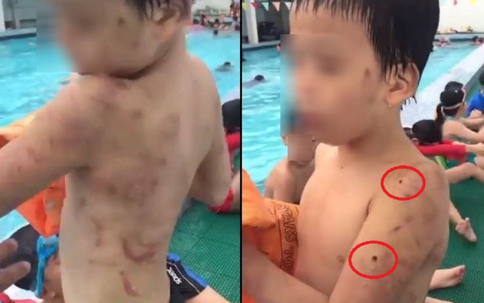 Bé trai với chi chít vết sẹo, lỗ thủng trên cơ thể nghi bị cha đẻ bạo hành Ảnh 2