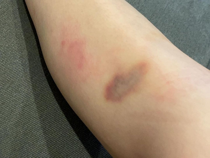 Baifern Pimchanok bị ngã ngựa khiến tay chân bầm tím, Yaya Urassaya giúp chườm lạnh ngay lập tức Ảnh 8