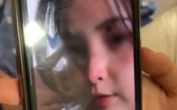 Nữ sinh 15 tuổi bị nhóm bạn đánh phải theo dõi chấn thương sọ não, rạn xương quai hàm Ảnh 2