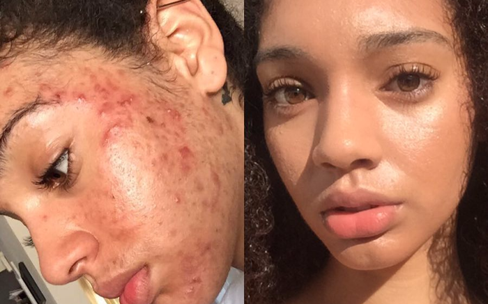 Người mẫu có làn da mụn chi chít như bánh đa kê tiết lộ cách trị mụn trong 30 ngày Ảnh 2