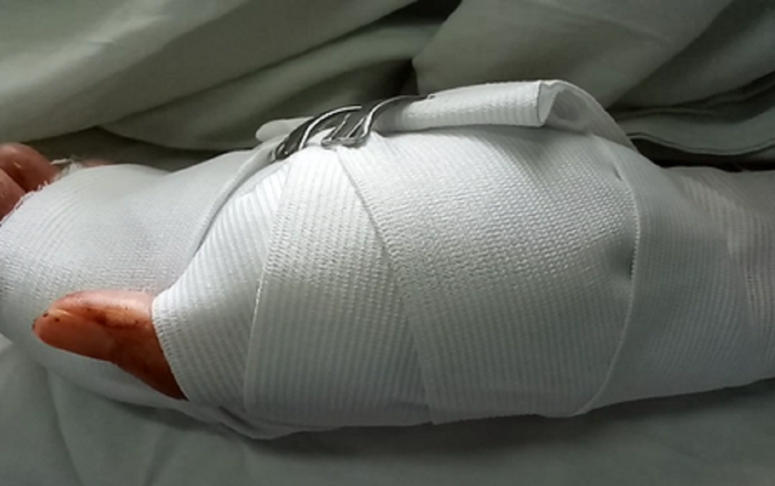 Người đàn ông 53 tuổi bị 2 thanh niên dùng mã tấu chém đứt lìa bàn tay trái Ảnh 2