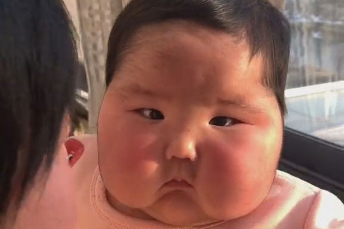 Mặt bé trai phình to gấp đôi sau khi dùng kem có chứa steroid.