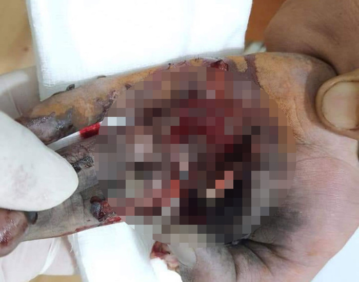 Bàn tay của thiếu niên bị dập nát do điện thoại phát nổ. Ảnh: VOV