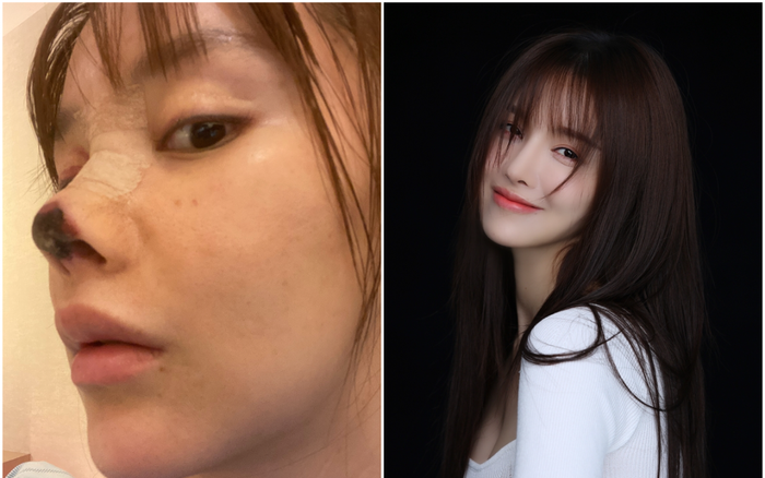 Mỹ nhân Trung Quốc hoại tử mũi vì 'dao kéo', đau khổ tới mức muốn tự tử Ảnh 2