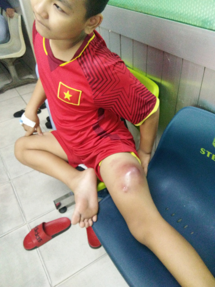 Trí Dũng bị ung thư mô ở đùi trái