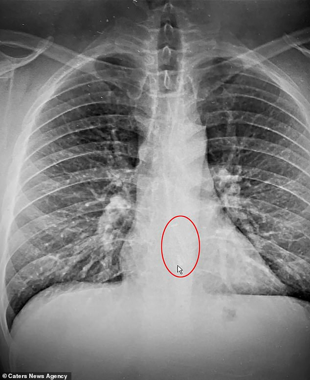 Kết quả chụp X-quang lại vạch trần 'thủ phạm' thật sự là chiếc tai nghe yêu quý mà anh đeo trong lúc ngủ.