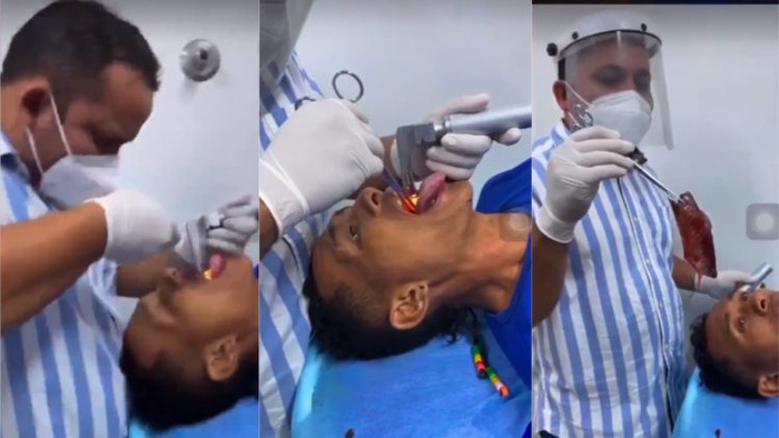 Con cá dài 18 cm được lấy ra khỏi cổ họng người đàn ông.