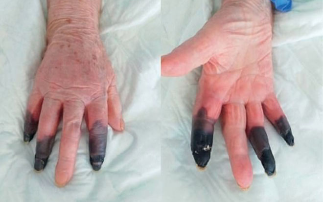 Bệnh nhân COVID-19 cụt 3 ngón tay do biến chứng nặng Ảnh 2