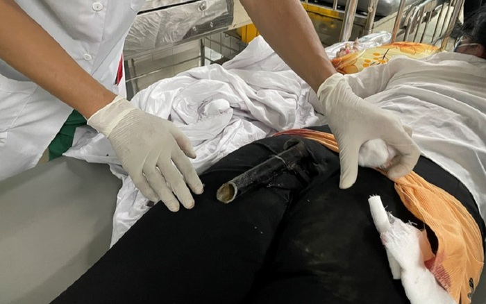 Cấp cứu thành công cô gái bị chân chống xe máy đâm vào mông sau va chạm giao thông Ảnh 2