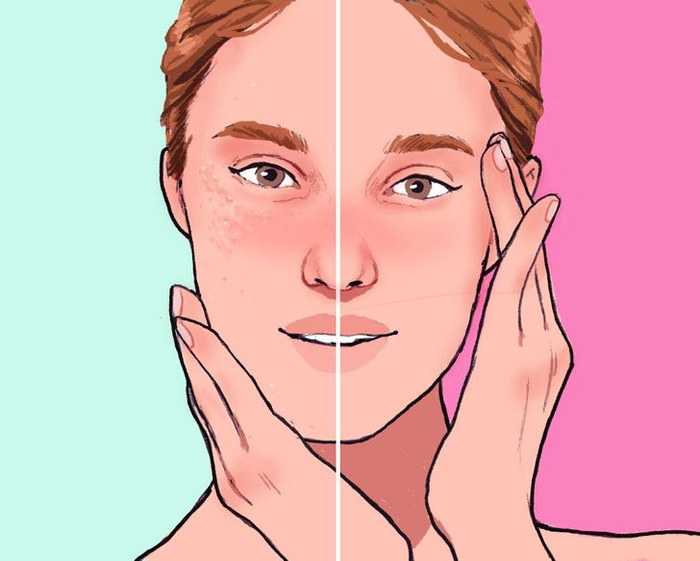 Cách xử lý mụn hạt kê (Milia) sần sùi quanh mắt Ảnh 3