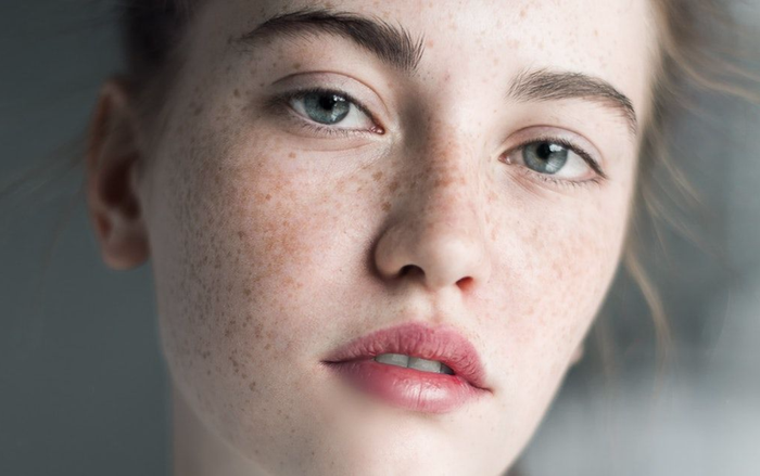 Cách xử lý mụn hạt kê (Milia) sần sùi quanh mắt Ảnh 2