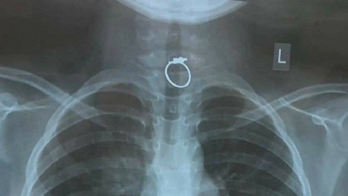 Phim chụp Xquang chiếc nhẫn mắc kẹt trong thực quản của bé gái. Ảnh: Pháp luật Việt Nam