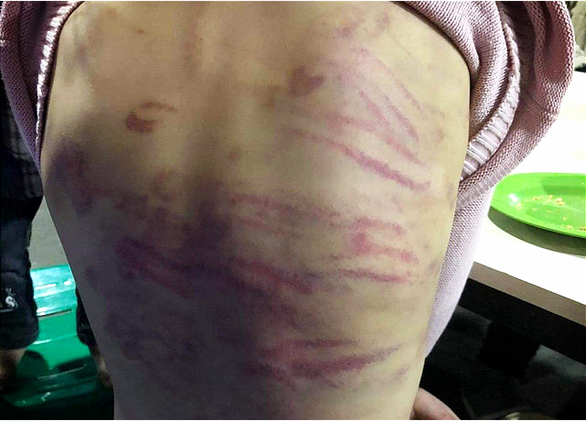 Vết thương trên người cháu B.