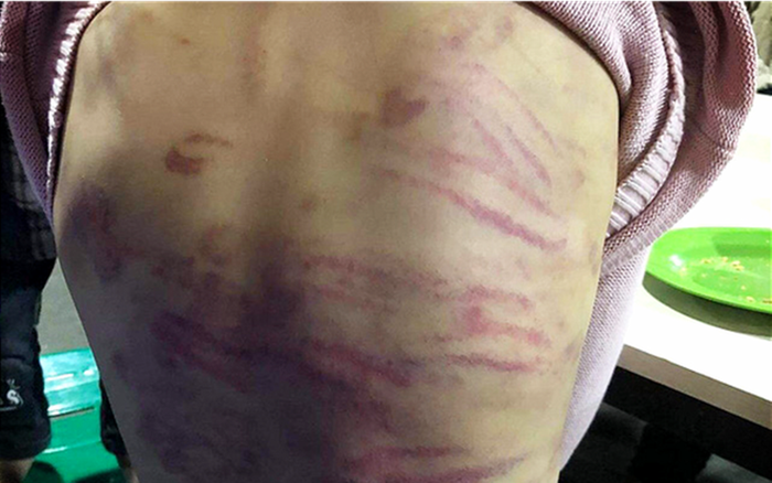 Bé gái 12 tuổi nghi bị mẹ ruột bạo hành, người tình của mẹ xâm hại nhiều lần Ảnh 2