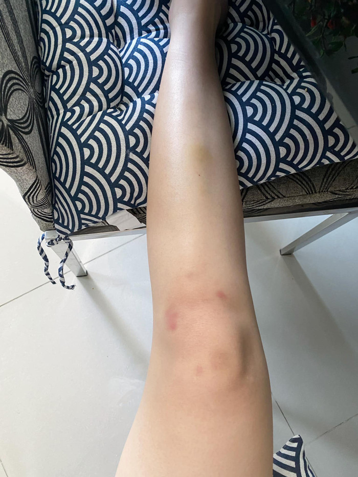 Chỉ vì tính tình hậu đậu khiến cô nàng bị thương (Ảnh chụp từ Facebook nhân vật)