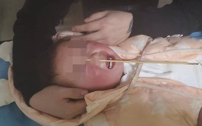 Bé gái 2 tuổi bị que tre đâm xuyên mũi trong lúc ăn xúc xích nướng Ảnh 2