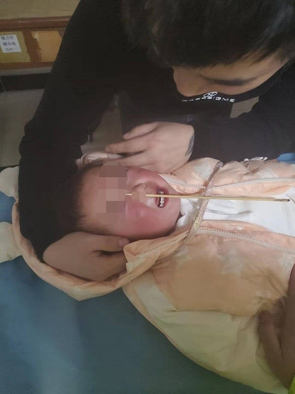 Cô bé Lele bị que tre đâm xuyên qua mũi, nhưng may mắn không gặp nguy hiểm.