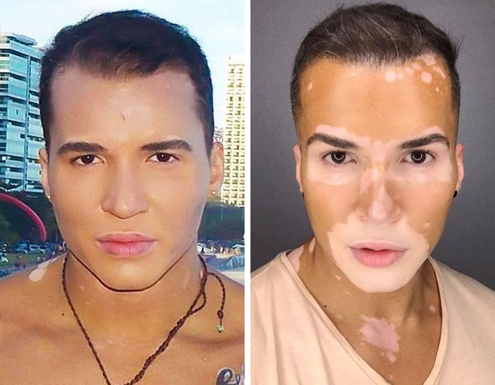 Nam người mẫu tự tin khoe khuôn mặt mắc bệnh bạch biến sau 10 năm che giấu Ảnh 3