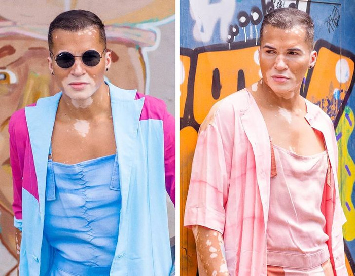 Nam người mẫu tự tin khoe khuôn mặt mắc bệnh bạch biến sau 10 năm che giấu Ảnh 5