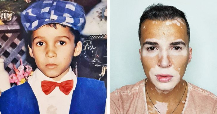 Nam người mẫu tự tin khoe khuôn mặt mắc bệnh bạch biến sau 10 năm che giấu Ảnh 1