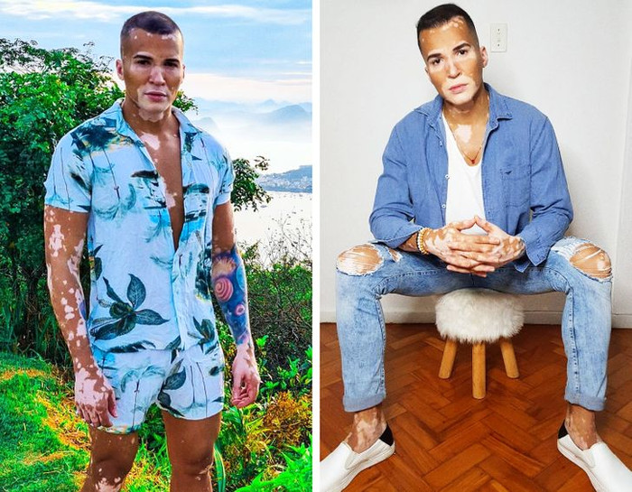 Nam người mẫu tự tin khoe khuôn mặt mắc bệnh bạch biến sau 10 năm che giấu Ảnh 2