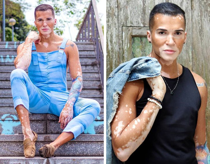 Nam người mẫu tự tin khoe khuôn mặt mắc bệnh bạch biến sau 10 năm che giấu Ảnh 6