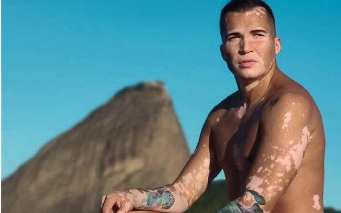 Nam người mẫu tự tin khoe khuôn mặt mắc bệnh bạch biến sau 10 năm che giấu Ảnh 2