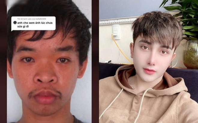 Thẩm mỹ 9 lần do xin việc thất bại, nam thanh niên Việt 'lột xác thành người khác' lên báo nước ngoài Ảnh 2