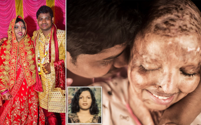 Cô gái mù loà, biến dạng mặt vì bị tạt axit rạng rỡ trong ngày cưới Ảnh 2