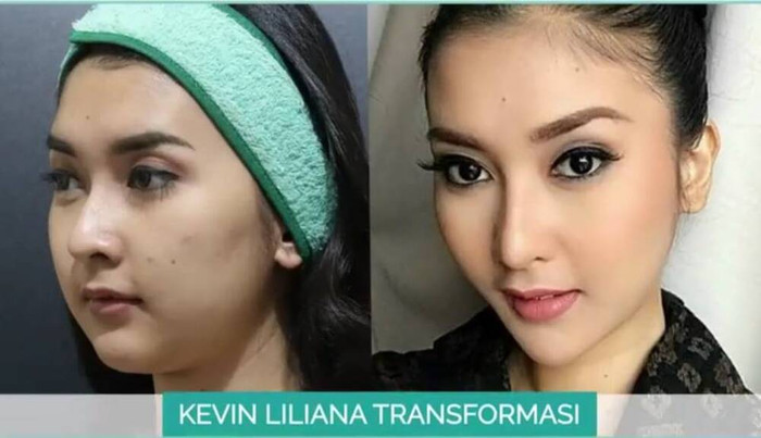 Kevin Lilliana Junaedy - Miss International 2017 trước và sau khi phẫu thuật thẩm mỹ. 