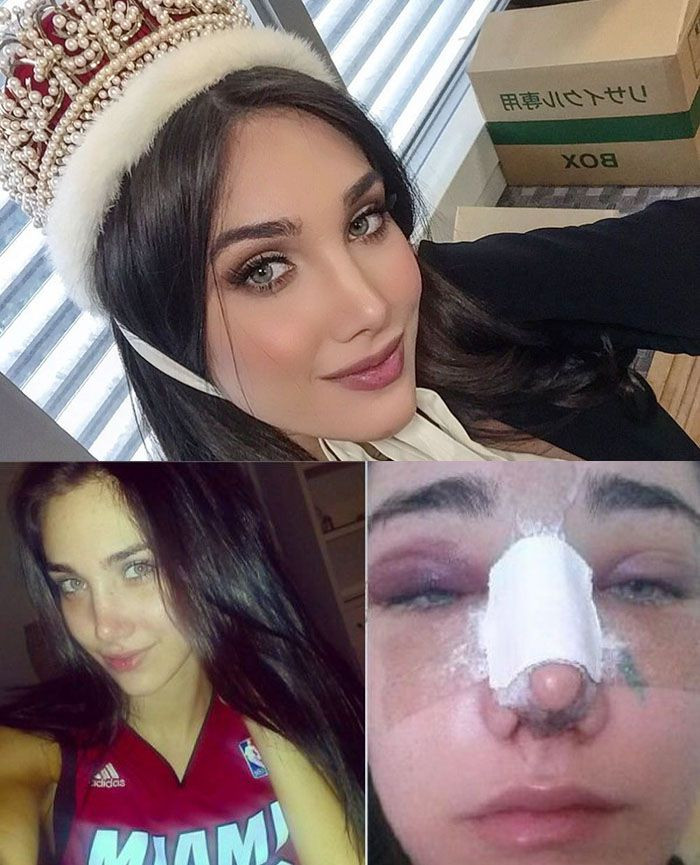 Edymar Martinez - Hoa hậu Quốc tế 2015 công khai những hình ảnh phẫu thuật thẩm mỹ. 