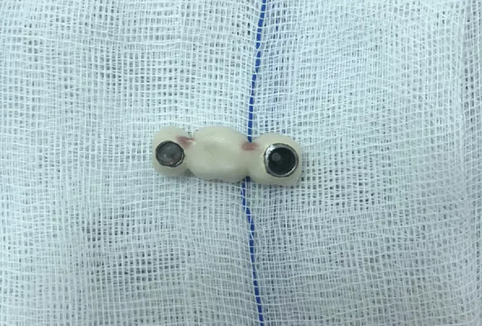 4 răng giả mà bệnh nhân nuốt được các y bác sĩ lấy ra
