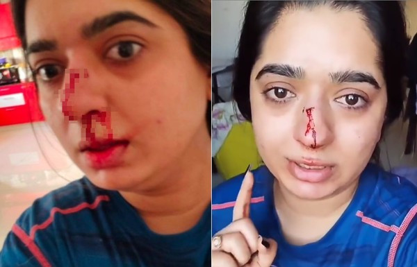 Chandranee chia sẻ hình ảnh bị chảy máu mũi và tố cáo nhân viên giao hàng của Zomato hành hung mình.