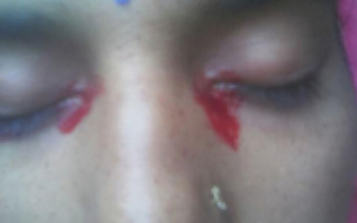 Người phụ nữ trẻ khóc ra máu khiến y học bối rối Ảnh 2