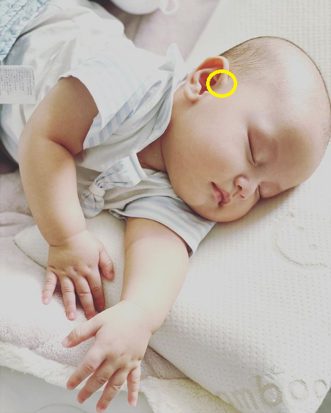 Cụ thể, ở tai của Leon có một cái lỗ nhỏ, đây có thể là dấu hiệu của bệnh rò luân nhĩ