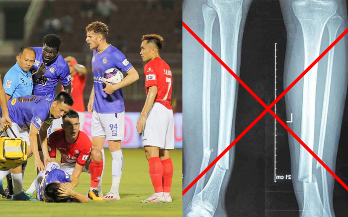 Thực hư ảnh chụp X-quang gãy chân của Hùng Dũng sau chấn thương kinh hoàng Ảnh 2