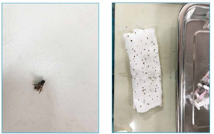 Cấp cứu thành công cụ ông 80 tuổi bị hơn 100 con ong vò vẽ đốt Ảnh 2