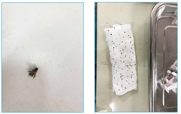 Nhiều vòi chích của ong dính trên da người bệnh được lấy ra. Ảnh: PV/Vietnam 