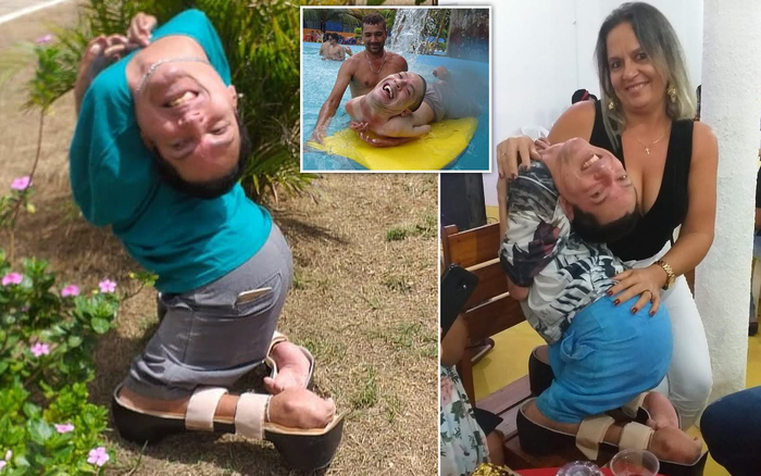 Cuộc sống đầy nghị lực của người đàn ông có đầu lộn ngược Ảnh 2