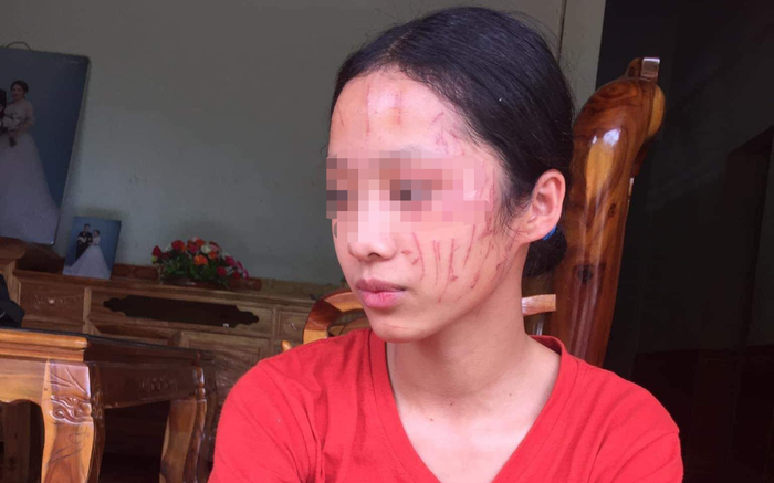 Xảy ra mâu thuẫn, nữ sinh lớp 8 ở Nghệ An bị cào xước mặt Ảnh 2