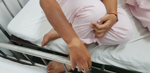 Học sinh bị bỏng sau vụ nổ bình gas mini tại trường THPT Phan Đăng Lưu. Ảnh: Nhật Linh/Tuổi Trẻ