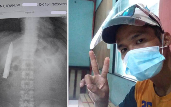 Đau tức ngực, người đàn ông choáng váng khi phát hiện lưỡi dao 10cm găm bên trong Ảnh 2